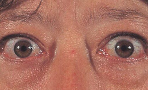 Thyroid Eye Disease - Graves' Disease