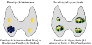 Diagnosis of Parathyroid Adenoma