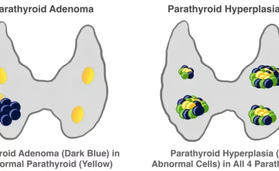 Diagnosis of Parathyroid Adenoma